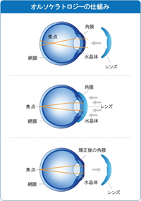 写真:オルソケラトロジーの仕組み